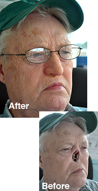 Custom implant retained ear prosthesis