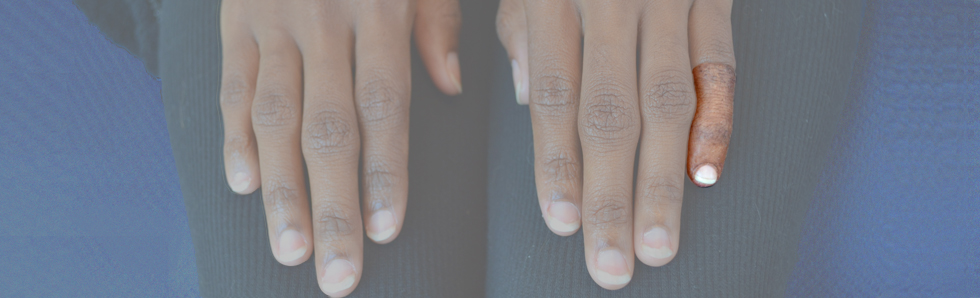 Somatic Prostheses Facial Prosthesis & Somato Prosthesis | Custom Prosthetic Ltd.